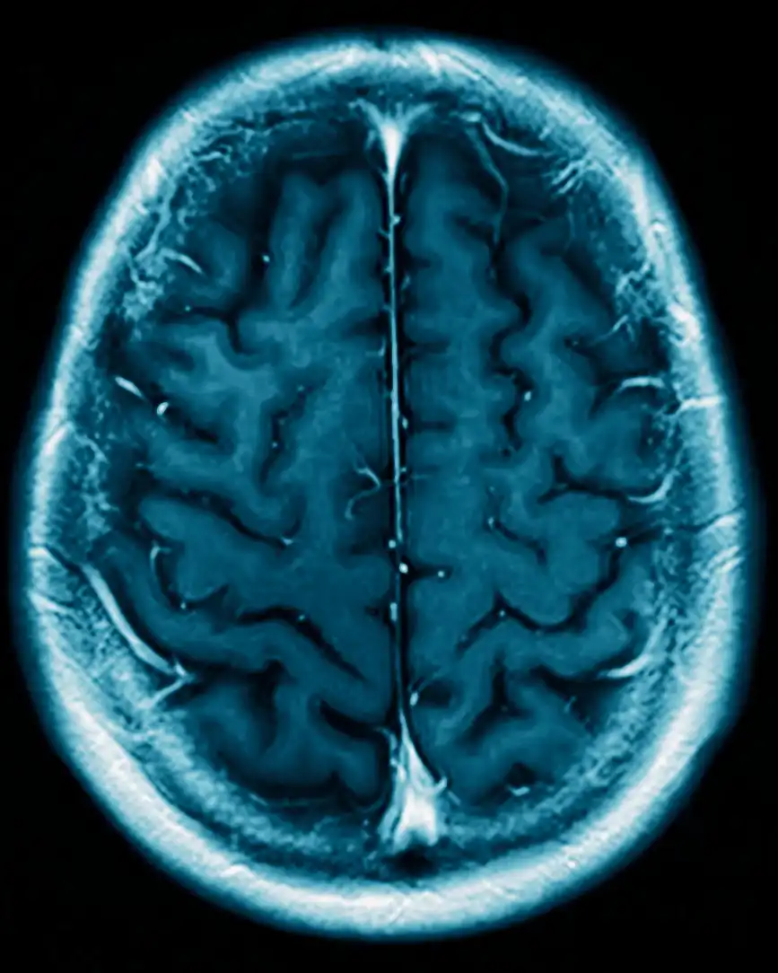 Fibromyalgie : activité physique adaptée et plasticité cérébrale